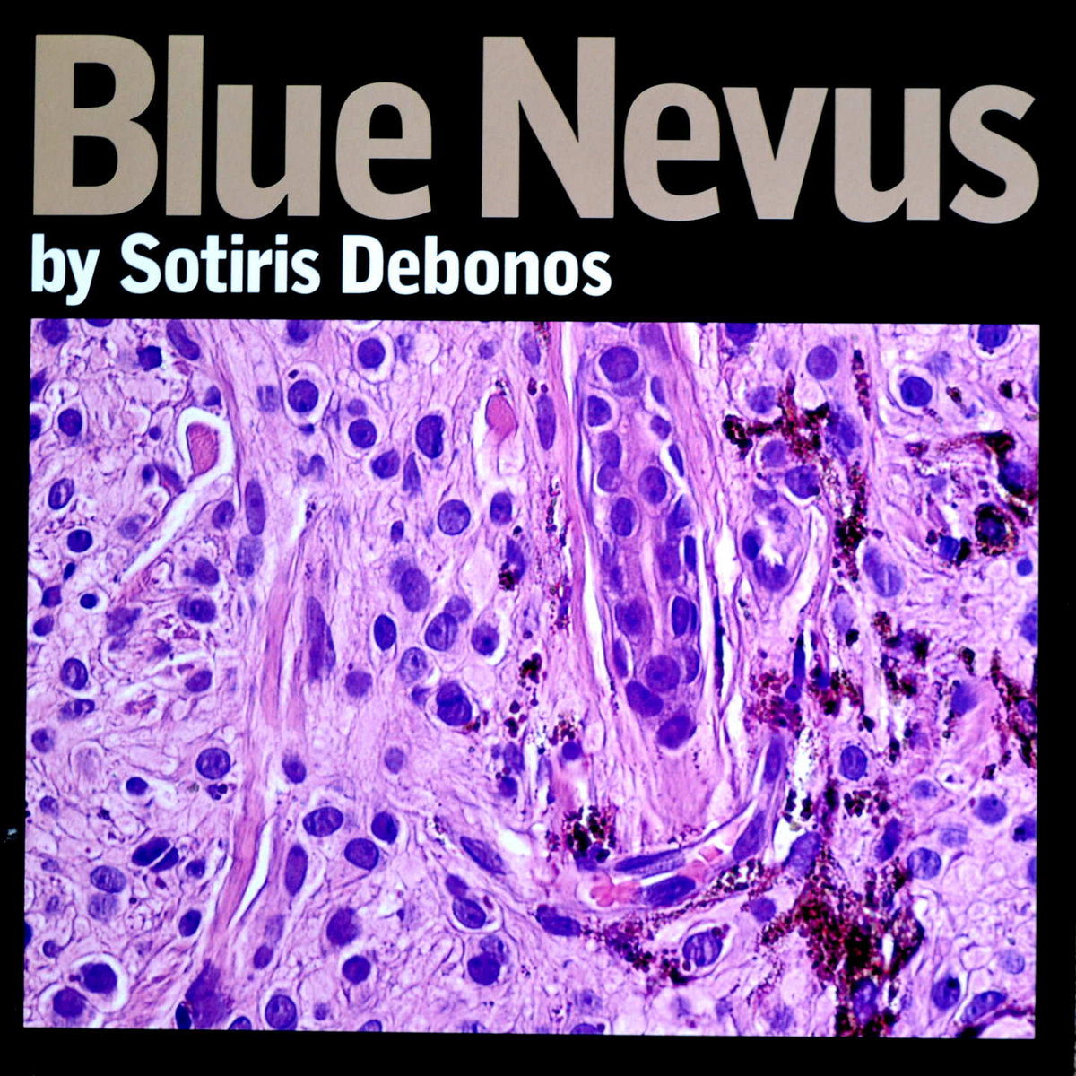 Sotiris Debonos – Blue Nevus